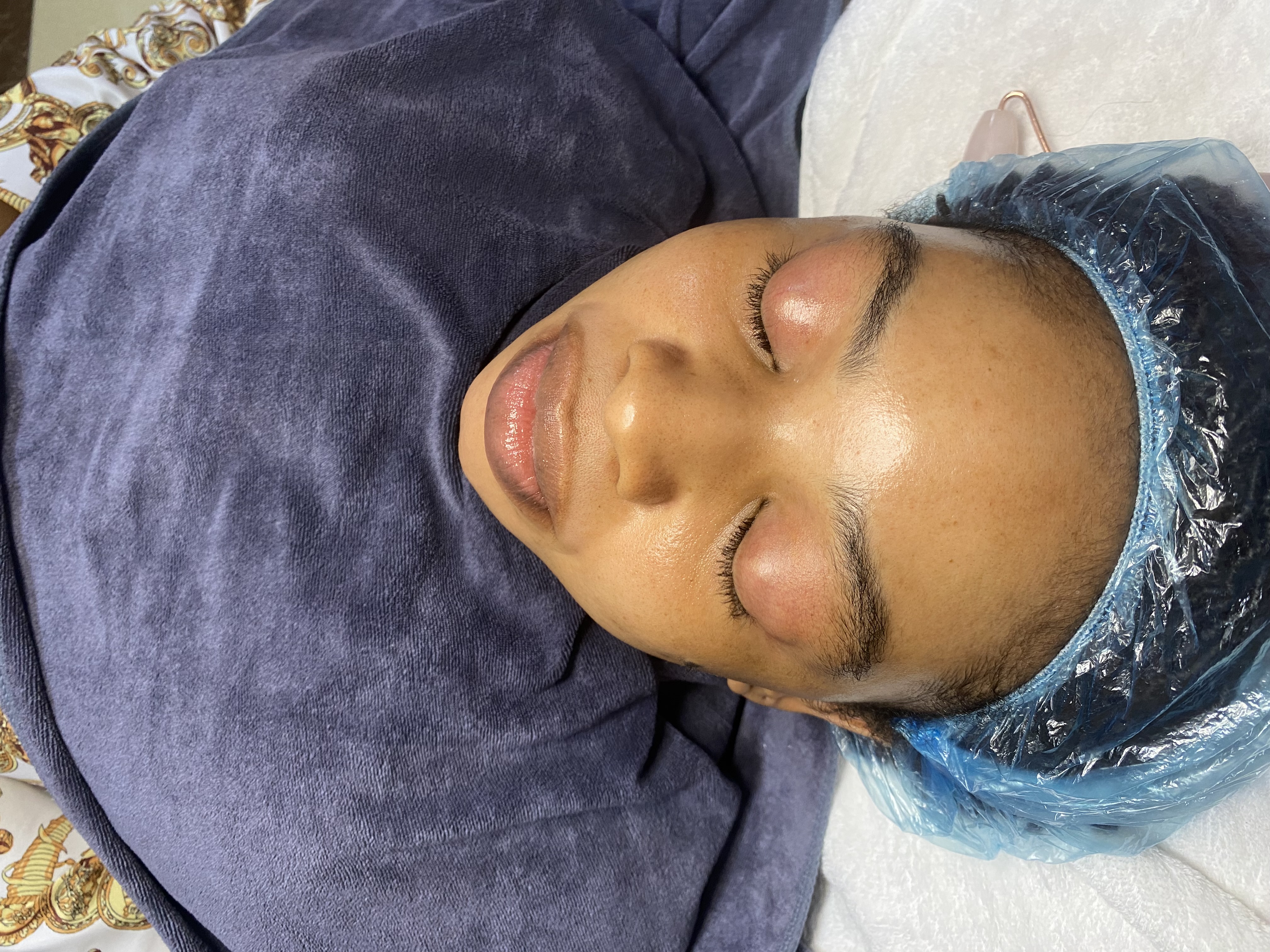 PRP treatment